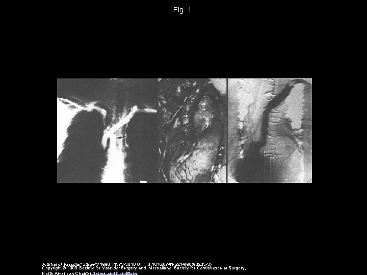 Fig. 1 Journal of Vascular Surgery 1990 11373 -381 DOI: (10. 1016/0741 -5214(90)90235 -3)