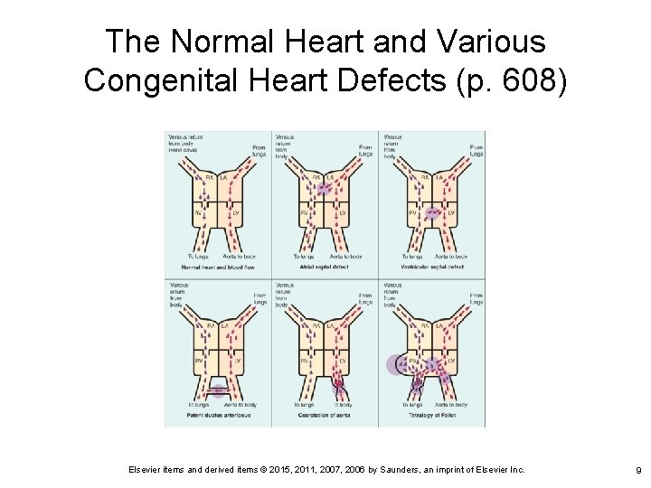 The Normal Heart and Various Congenital Heart Defects (p. 608) Elsevier items and derived