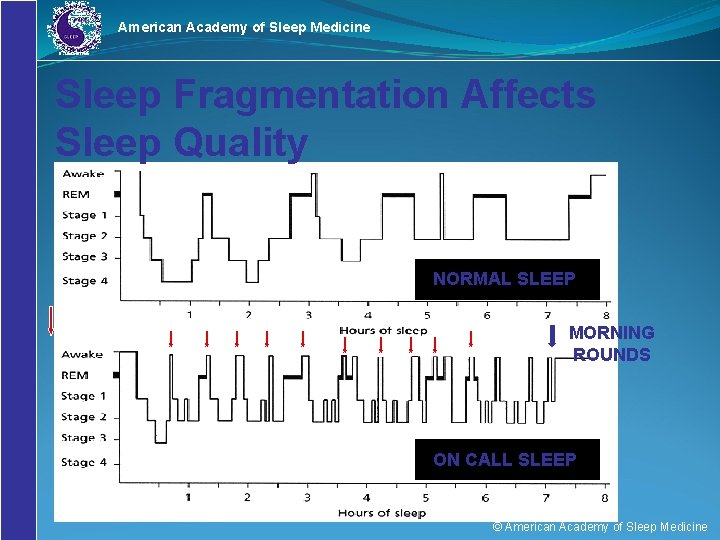 American Academy of Sleep Medicine Sleep Fragmentation Affects Sleep Quality NORMAL SLEEP = Paged