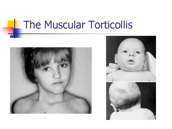 The Muscular Torticollis 