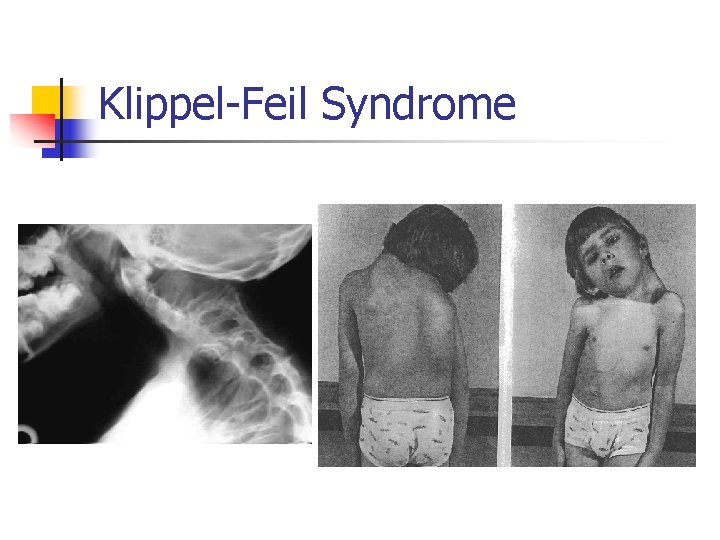 Klippel-Feil Syndrome 