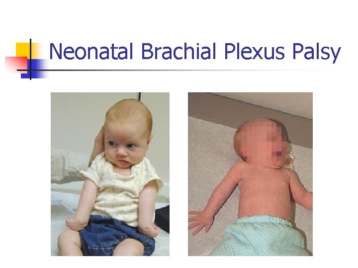 Neonatal Brachial Plexus Palsy 
