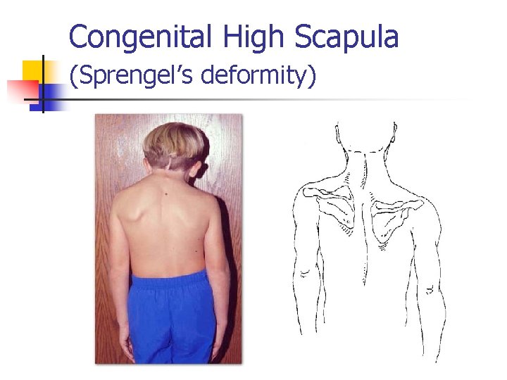 Congenital High Scapula (Sprengel’s deformity) 