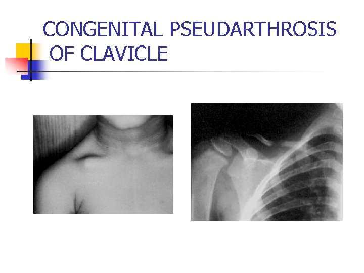 CONGENITAL PSEUDARTHROSIS OF CLAVICLE 