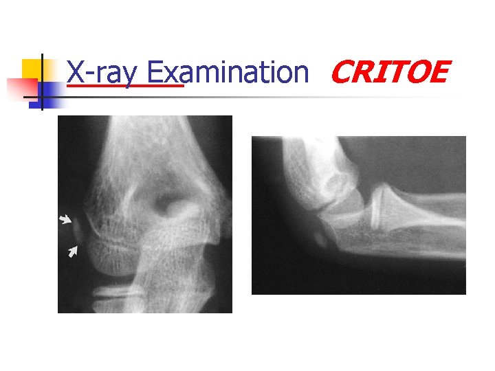 X-ray Examination CRITOE 