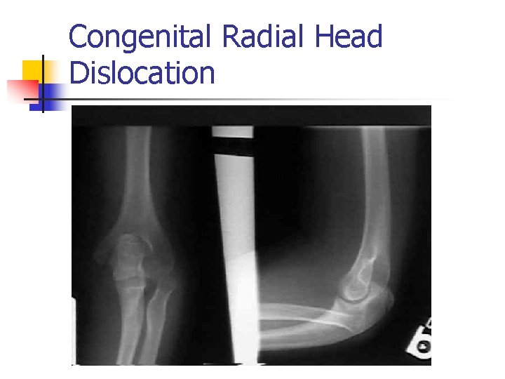 Congenital Radial Head Dislocation 