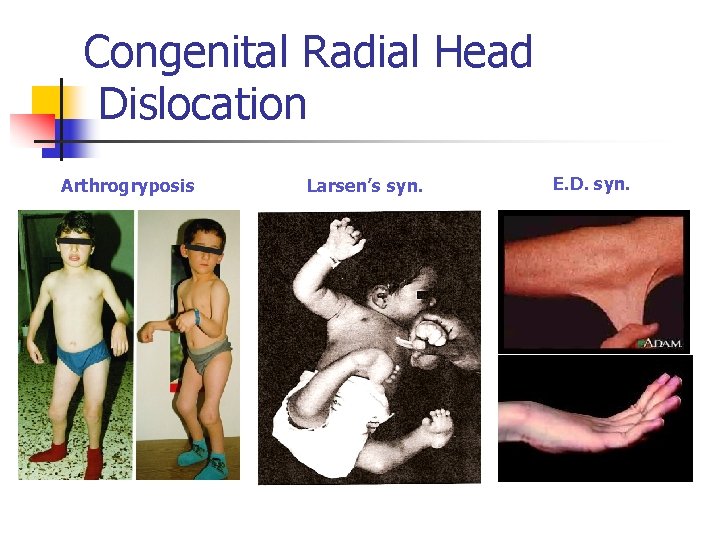 Congenital Radial Head Dislocation Arthrogryposis Larsen’s syn. E. D. syn. 