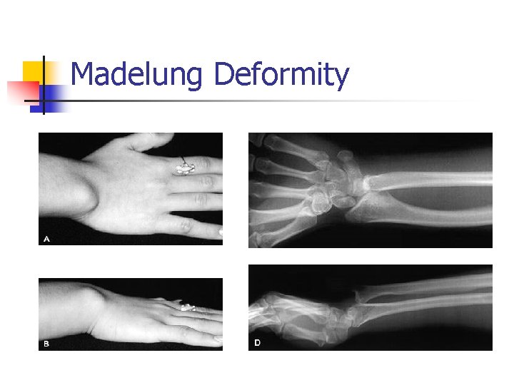 Madelung Deformity 