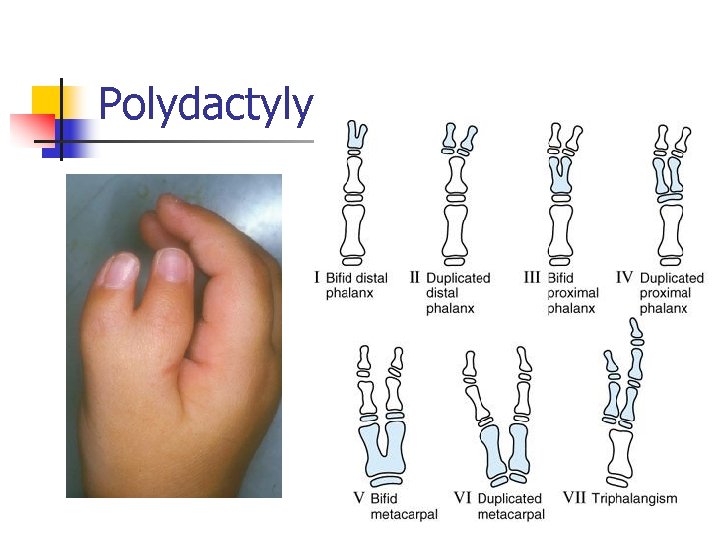 Polydactyly 