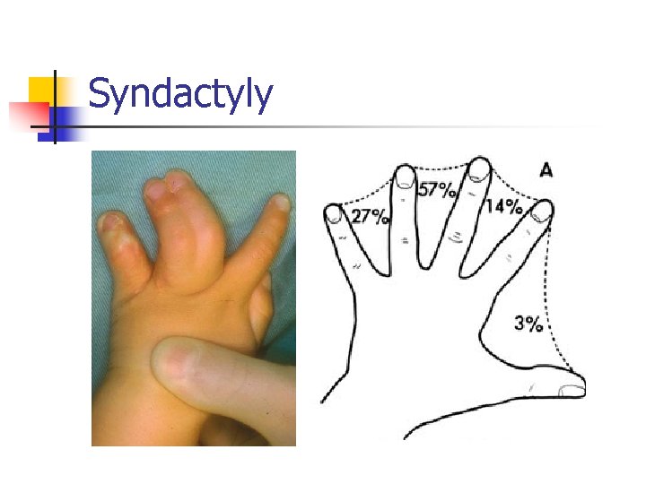 Syndactyly 