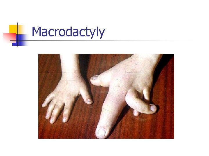 Macrodactyly 