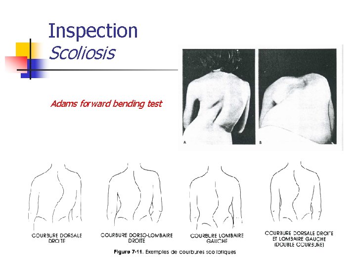 Inspection Scoliosis Adams forward bending test 