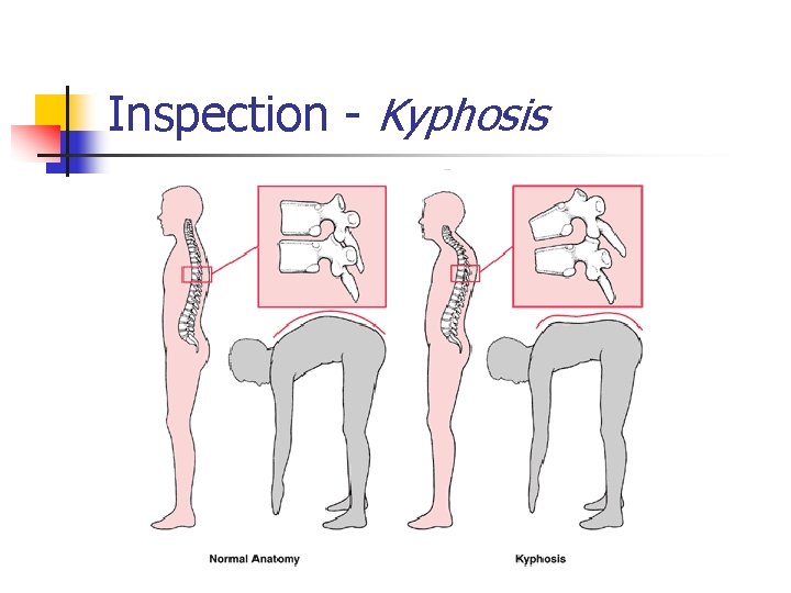 Inspection - Kyphosis 