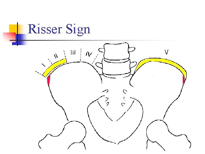 Risser Sign 