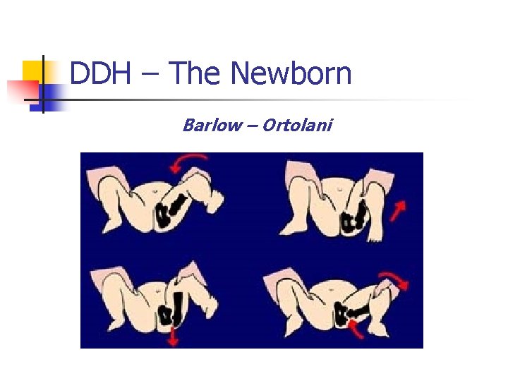 DDH – The Newborn Barlow – Ortolani 