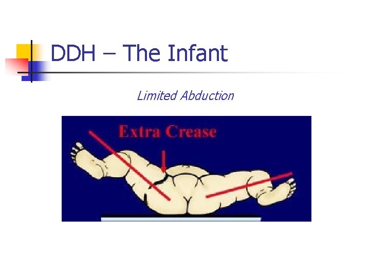 DDH – The Infant Limited Abduction 