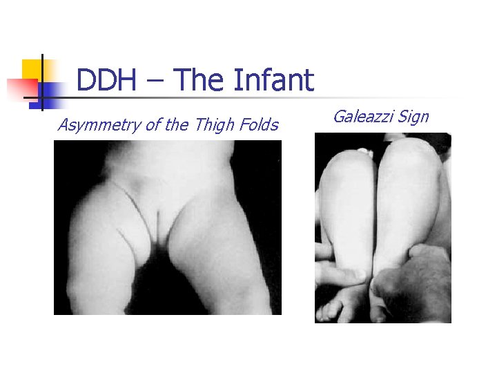 DDH – The Infant Asymmetry of the Thigh Folds Galeazzi Sign 