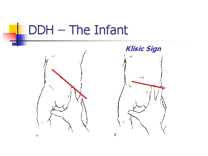 DDH – The Infant Klisic Sign 