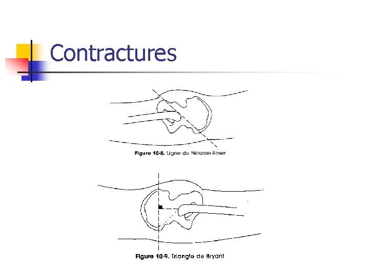 Contractures 