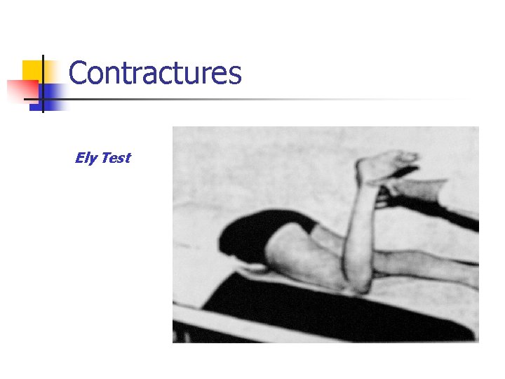 Contractures Ely Test 
