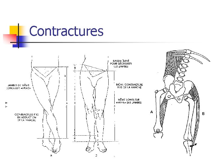 Contractures 