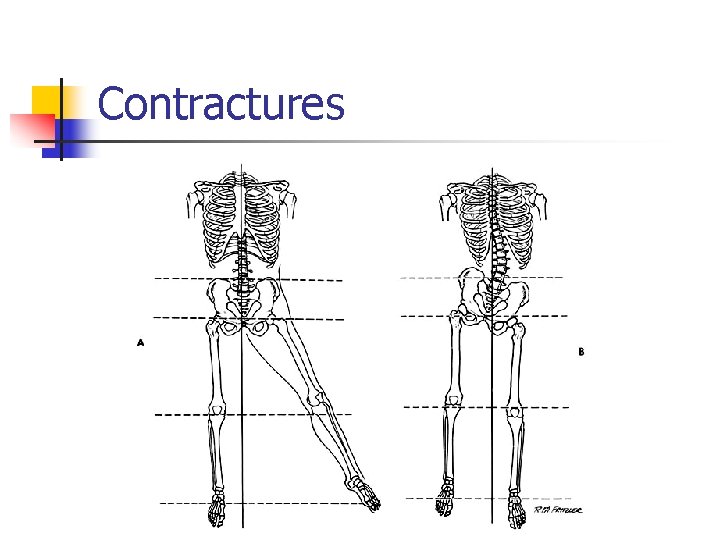 Contractures 