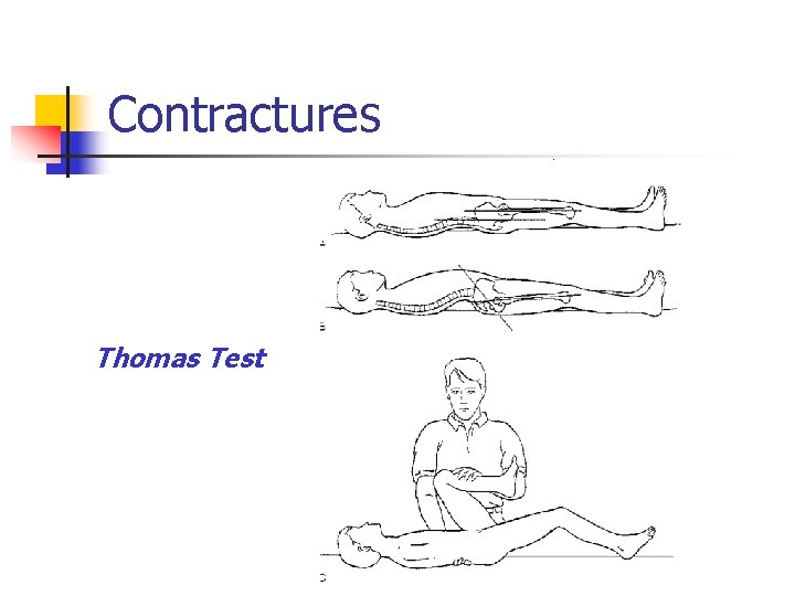 Contractures Thomas Test 