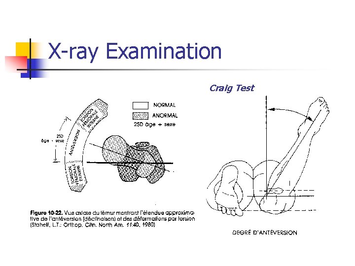 X-ray Examination Craig Test 