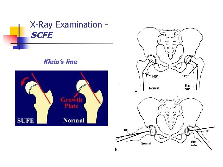 X-Ray Examination - SCFE Klein’s line 