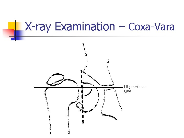 X-ray Examination – Coxa-Vara 