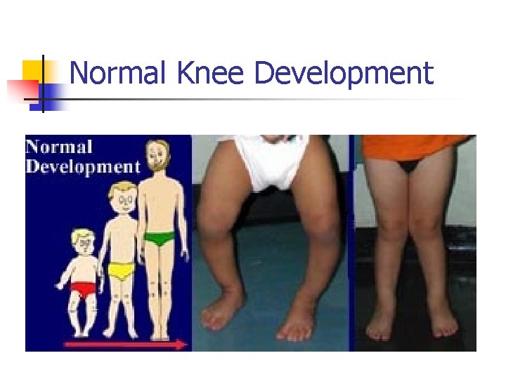 Normal Knee Development 