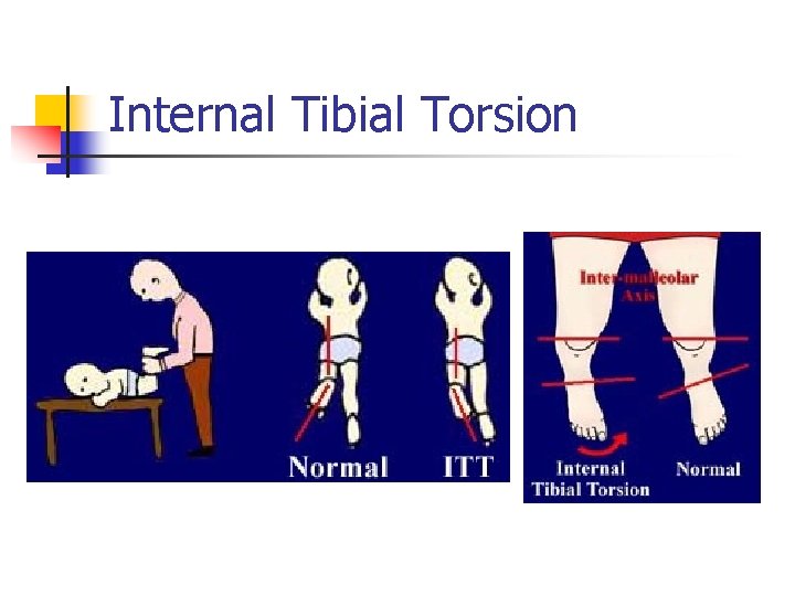 Internal Tibial Torsion 