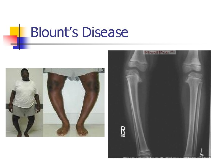 Blount’s Disease 
