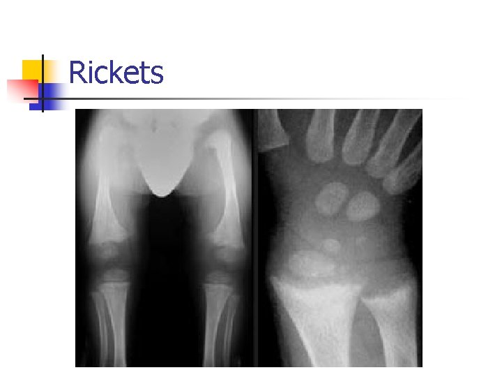 Rickets 