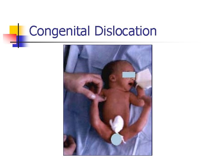 Congenital Dislocation 