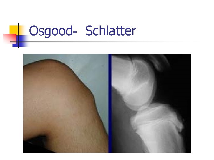 Osgood- Schlatter 