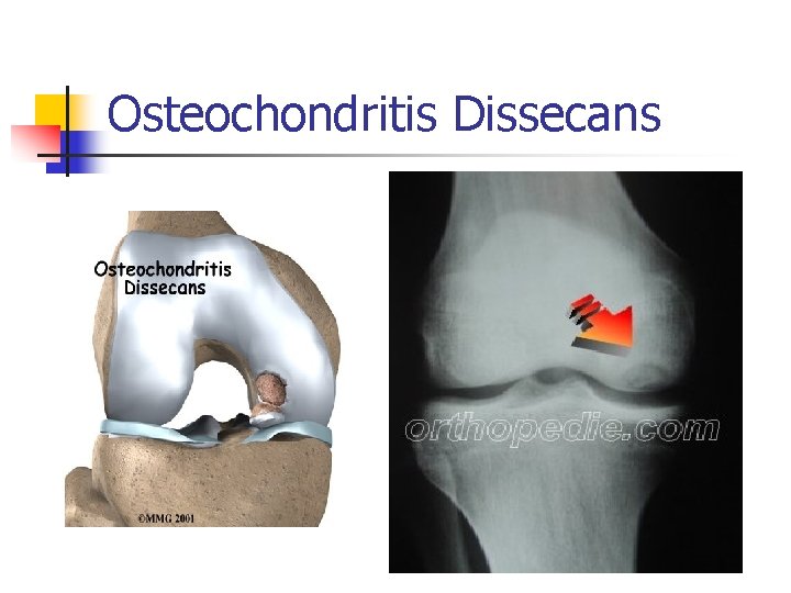 Osteochondritis Dissecans 