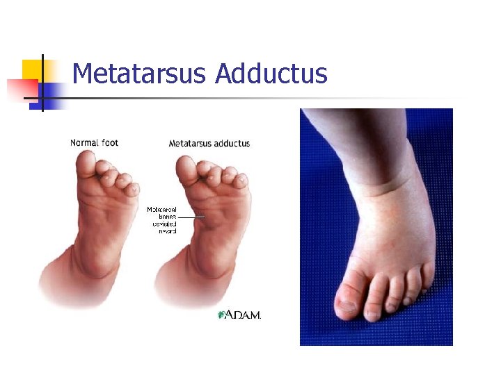 Metatarsus Adductus 