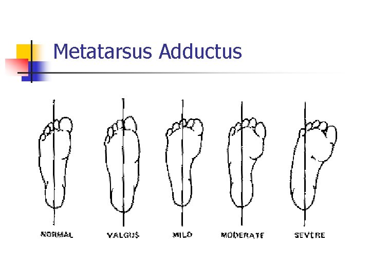 Metatarsus Adductus 