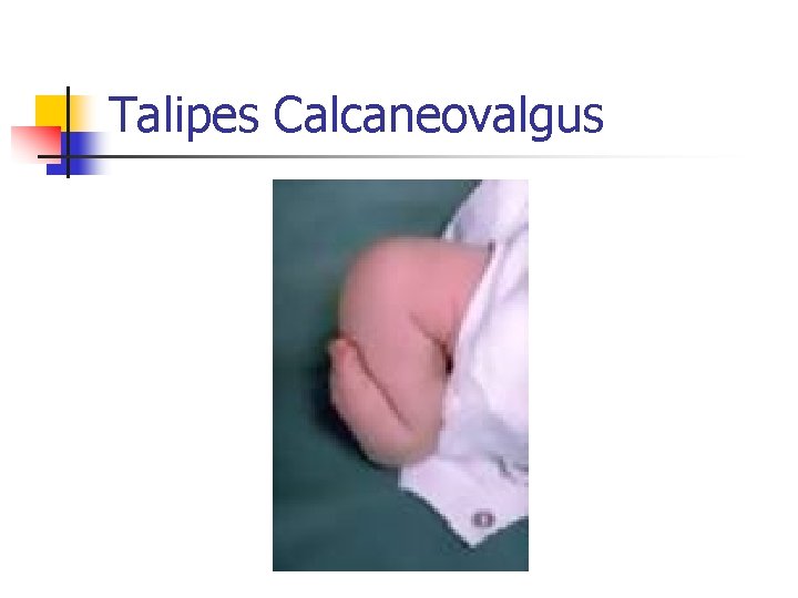 Talipes Calcaneovalgus 
