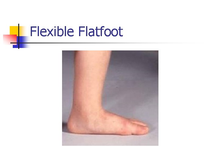 Flexible Flatfoot 