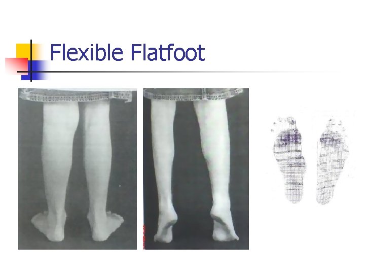 Flexible Flatfoot 