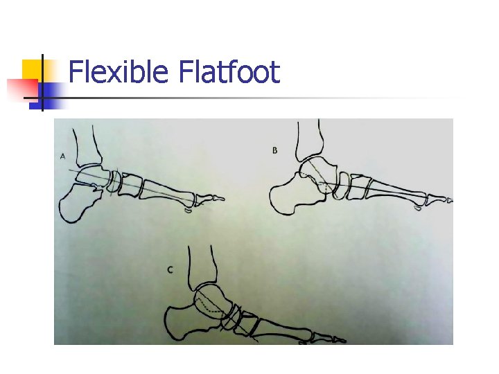 Flexible Flatfoot 