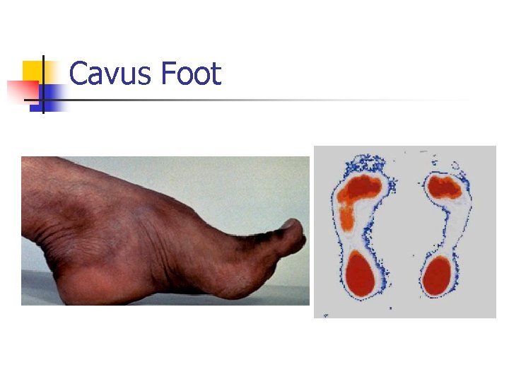 Cavus Foot 