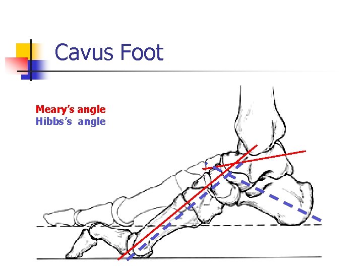 Cavus Foot Meary’s angle Hibbs’s angle 