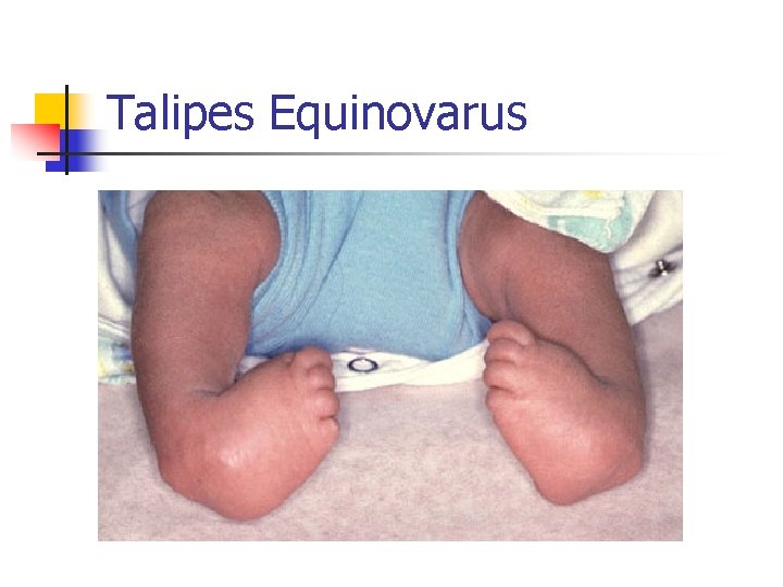 Talipes Equinovarus 