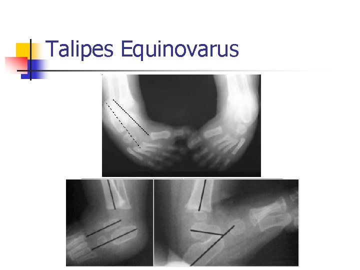 Talipes Equinovarus 