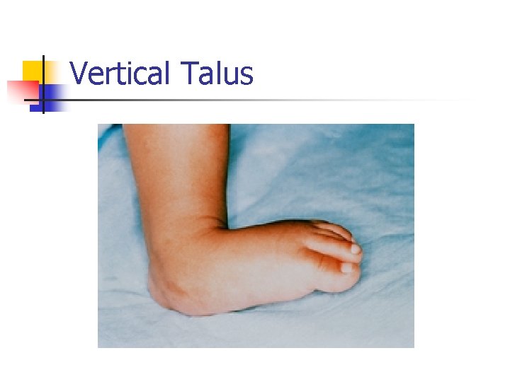 Vertical Talus 
