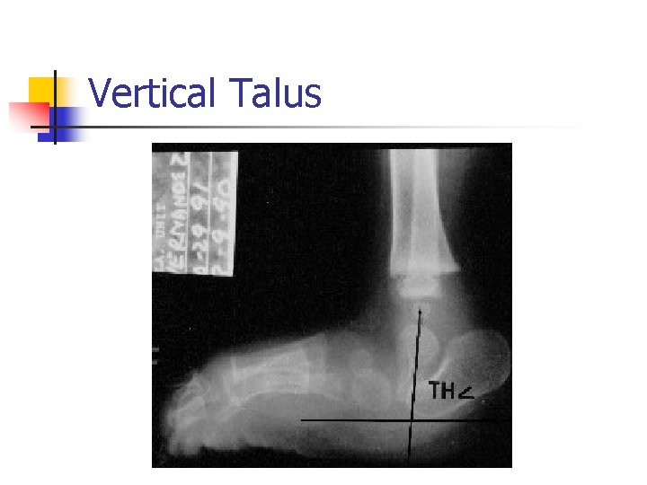Vertical Talus 