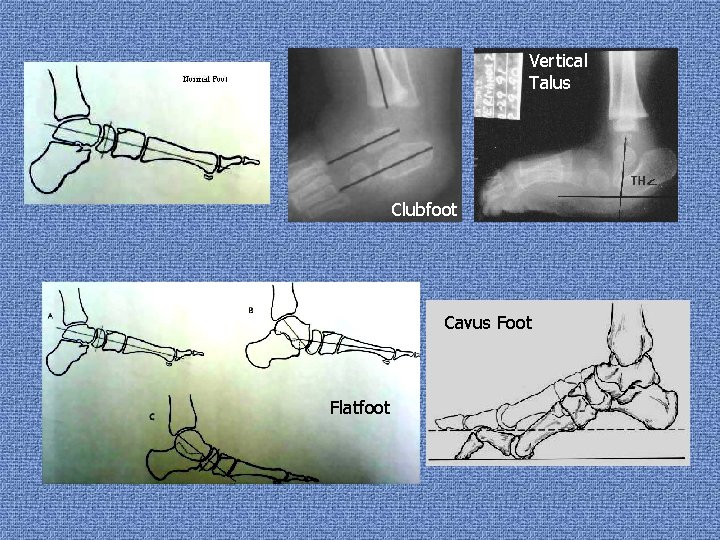 Vertical Talus Clubfoot Cavus Foot Flatfoot 